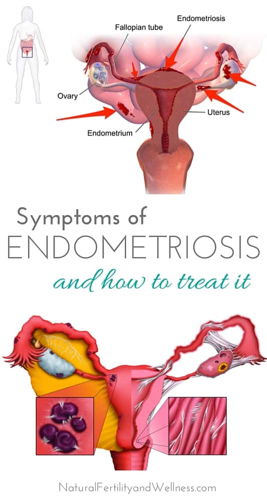 Endometriosis Treatment Through Diet