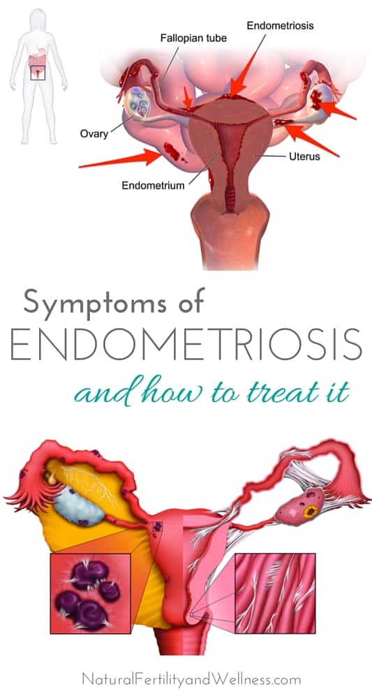 What is endometriosis