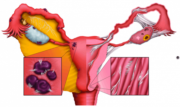 what endometriosis looks like